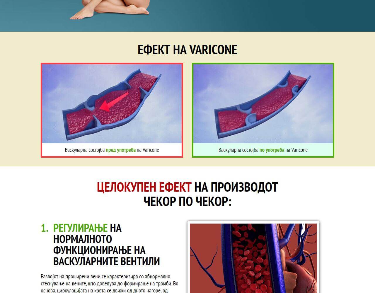 Varicone 5